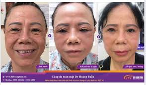 Ngay sau phẫu thuật căng da mặt 12h đây cả nhà