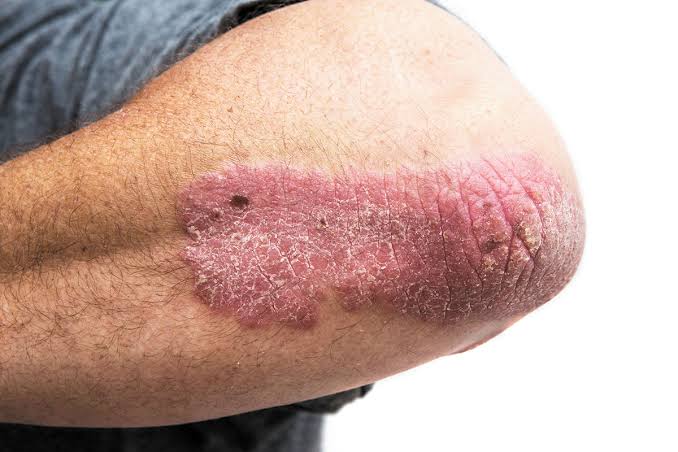 Image result for psoriasis