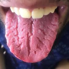 Image result for Fissured tongue
