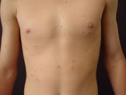 Extensive pityriasis alba (epa) is a variant that is more common in adults and has a more generalized and truncal distribution. Definiciones Dermatologia Archives Seite 38 Von 233 Dermatly Com El Sitio De Tu Piel