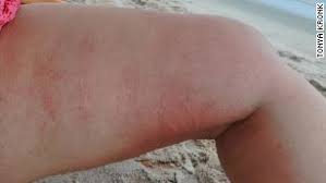 Common signs and symptoms of jellyfish stings include: More Than 800 People Were Stung By Jellyfish Along Florida Beaches In Three Days Cnn
