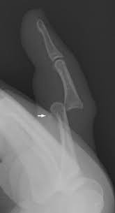 Image result for Volar PIP Dislocation