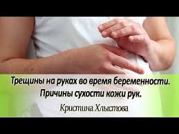 вся правда о женском здоровье как избежать опасных проблем 30 Treshiny Na Rukah Vo Vremya Beremennosti Prichiny Suhosti Kozhi Ruk Kristina Hlystova Youtube Treshinynarukah Suhostruk Zamasliv Kozha Ruki
