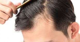 Loss Of Hair Prevention Woman Home Remedies All Natural Remedies To Avoid Hair Loss And Advertise Hair Growt Sac Dokulmesi Saglikli Sac Sac Dokulme Tedavileri