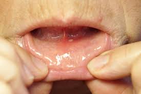 Image result for Mouth ulcers roof of mouth