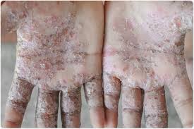 Image result for scabies symptoms