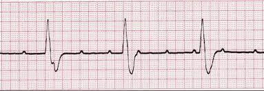 Check spelling or type a new query. Complete Heart Block Or Third Degree Atrioventricular Av Block Apollo Hospitals Blog