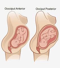 Image result for Manual Rotation in Occipitoposterior Presentation