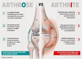 Nous allons avoir l'honneur de vous charger, répondit aramis en levant son chapeau d'une main et tirant son épée de l'autre. Arthrose Arthrite Quelles Differences