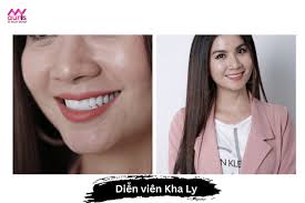 Sao việt làm răng sứ ở đâu