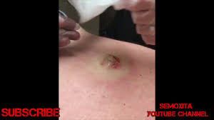 She's had videos go viral on her channel, of her popping everything from cysts, blackheads, whiteheads and also taking care of other skin conditions. Pimple Popping 2019 Acne Cyst Explosion Blackhead Removal Video Whiteheads New Youtube
