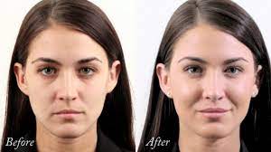 Cheek fillers are a safe and effective way to lift and sculpt your cheekbones. Monica S Dermal Filler Treatment To Cheeks Lips Temples Forehead Youtube