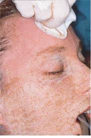 Cutaneous laser resurfacing