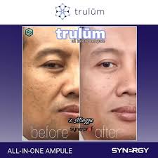 Check spelling or type a new query. Distributor Obat Tradisional Untuk Keriput Trulum All In One Ampoule Di Wilayah Batu Sms 62811 233 8376 Solusi Keriput Ma Obat Jerawat Jerawat Kulit Sensitif