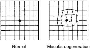 age related macular degeneration definition of age related