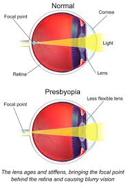 Presbyopia Wikipedia