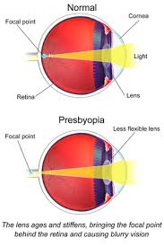 presbyopia wikipedia