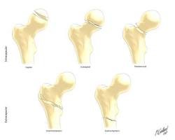 Bildmotiv: Femoral neck fracture
