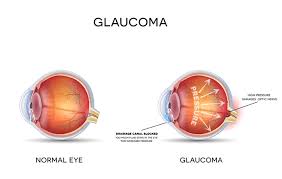 Image result for Glaucoma