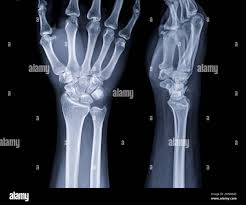 Image result for Wrist XRay