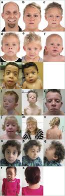 Women with knowledge of health care and men with few family relationships are particularly vulnerable to developing this disorder. Autosomal Recessive Noonan Syndrome Associated With Biallelic Lztr1 Variants Genetics In Medicine