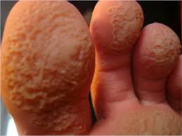 Image result for Erythrasma