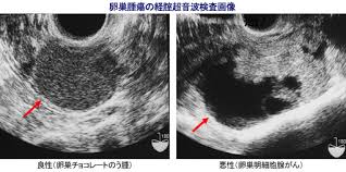「卵巣がん 原因」の画像検索結果