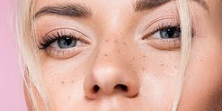 Image result for Freckled skin