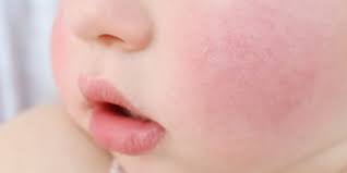 Rote Wangen Beim Baby Mogliche Ursachen Im Uberblick