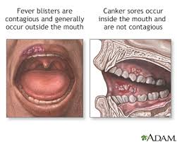 Image result for Canker sores symptoms roof of the mouth