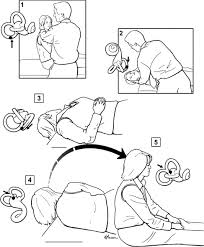 Image result for Canalith Repositioning Procedure