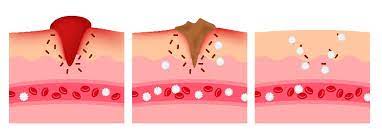 Immune Mediated Thrombocytopenia
