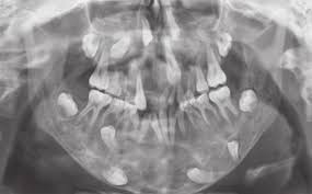 A hereditary condition characterized by swelling of the jawbones and especially in young children by a characteristic facies marked by protuberant cheeks and upturned. 11 Year Old Male With Cherubism Showing The Typical Disorganization Of Download Scientific Diagram