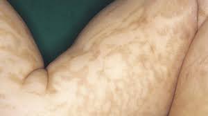 Franceschetti syndrom in anderen sprachen: Incontinentia Pigmenti Bloch Sulzberger Altmeyers Enzyklopadie Fachbereich Dermatologie