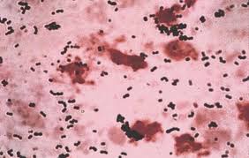 Image result for Group B Streptococcus Prophylaxis