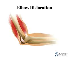 Image result for Elbow Dislocation