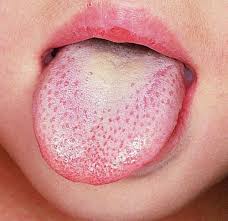 El Color Y Textura De Tu Lengua Dice Mucho Sobre Tu Salud La De La Foto Predice Que Algo Malo Pasa Upsocl
