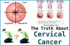 Learn about its symptoms and if your gp thinks you might have cervical cancer, you should be referred to see a specialist within two weeks. Cervical Cancers