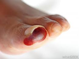 Check spelling or type a new query. What Are The Most Common Causes Of Toe Blisters
