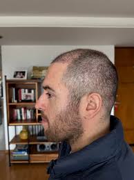 1 month mark. How does it look? : r/HairTransplants