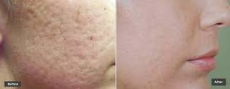 Skin Resurfacing Treatment Laser Genesis Skin Toning Scar Removal ...