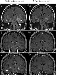Although the perivascular lesion localization is a pathologic hallmark of clippers, an intralesional vessel could not be depicted in vivo by using conventional mri at lower magnetic field strength. Figure 3 From Chronic Lymphocytic Inflammation With Pontine Perivascular Enhancement Responsive To Steroids Clippers With Limbic Encephalitis Semantic Scholar