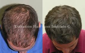 You're in the right place. Before And After Hair Growth Treatment Photos