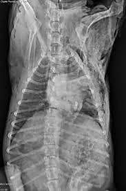 Image result for Flail Chest