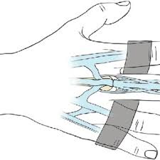 Image result for Elson Extensor Tendon Test