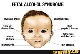 Rupture of the bladder or diaphragm; Fetal Alcohol Syndrome Low Nasal Bridge Epicanthal Folds Minor Ear Short Abnormalities Palpebral Fissures Flat Midtace Indistinct And Short Nose Micrognathia Thin Upper Tip
