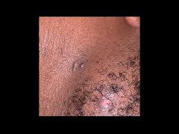 Not painful, not grown in size.any ideas how to dig deep? So Many Ingrown Hairs How To Extract Hair Bump Youtube