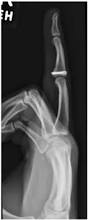 Image result for Volar PIP Dislocation