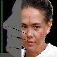 Smartphone-Based Facial Scanning as a Viable Tool for Fa- cially Driven  Orthodontics?