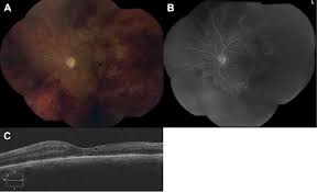 Vancomycin-Associated Hemorrhagic Occlusive Retinal Vasculitis
